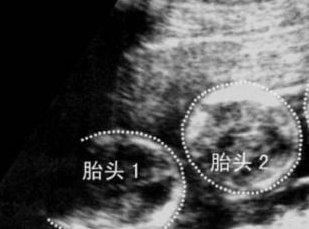 广州三代试管婴儿费用总共多少钱？钱都花在哪里了？